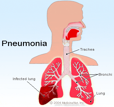 – 201111pneumonia