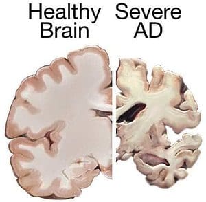 Healthy Brain vs Alzheimer's Disease 