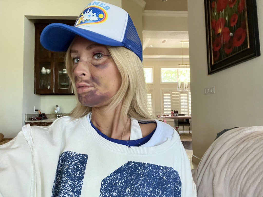PIC FROM Kennedy News and Media (PICTURED: SEVERE SWELLING AND BRUISING EXPERIENCED BY JESSICA MACKO, 44, FROM TEXAS AFTER HAVING DENTAL IMPLANTS) A mum claims dental implants implants left her face with the 'worst bruising ever' - leaving her looking like a human 'Rorschach inkblot test'. Jessica Macko had been experiencing 'agonising' pain as an eating disorder she'd had when she was younger had 'eroded' all her teeth.The 44-year-old decided to have All-on-4 dental implants earlier this month [April 2nd] to fix her ongoing dental issues, a procedure where a set of four dental implants replace 'loose, rotten, missing or failing teeth'.DISCLAIMER: While Kennedy News and Media uses its best endeavours to establish the copyright and authenticity of all pictures supplied, it accepts no liability for any damage, loss or legal action caused by the use of images supplied and the publication of images is solely at your discretion. SEE KENNEDY NEWS COPY - 0161 697 4266
